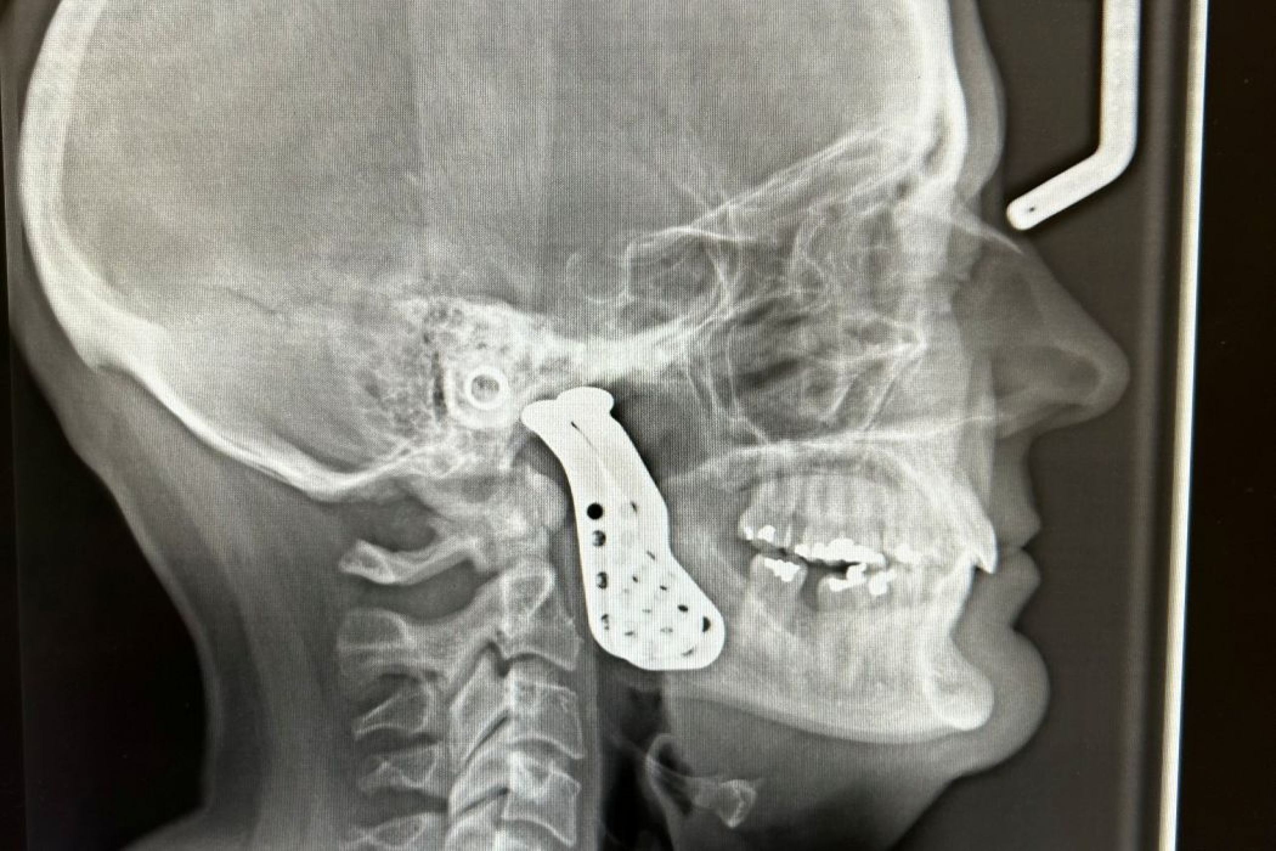 X-ray of head shows the jaw joint replacement. 
