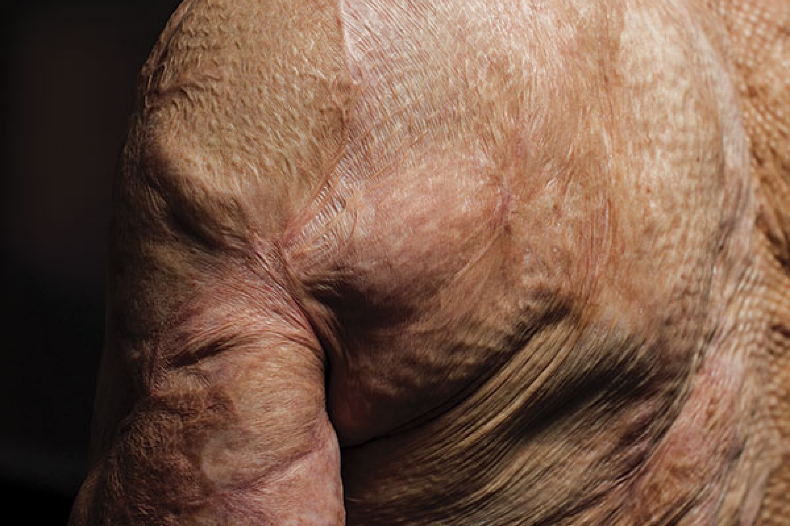 The scarred skin of a man's back.