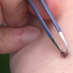 a tick about to be pulled off an arm with tweezers