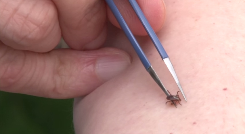 a tick about to be pulled off an arm with tweezers