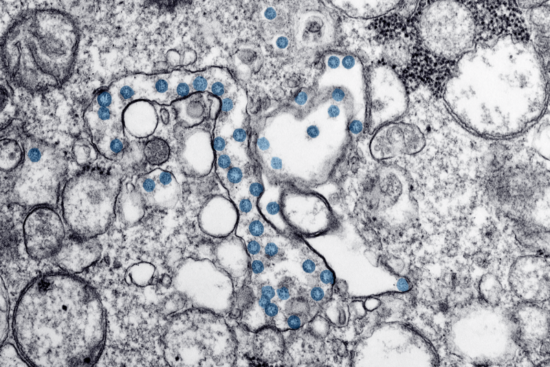 Transmission electron microscopic image of an isolate from the first U.S. case of COVID-19, formerly known as 2019-nCoV. The spherical viral particles, colorized blue, contain cross-sections through the viral genome, seen as black dots.