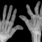 Xray of hands deformed by rheumatoid arthritis.