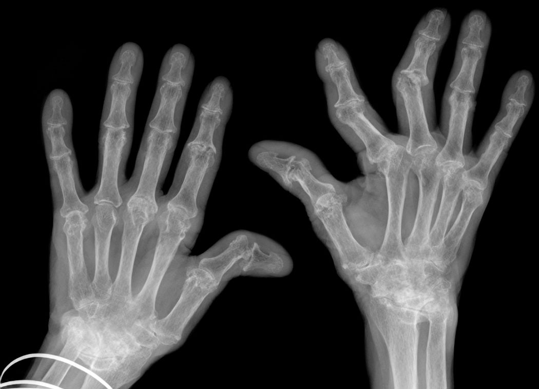 Xray of hands deformed by rheumatoid arthritis.