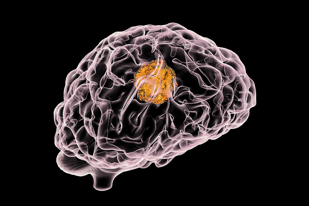 Digital illustration of a brain with a tumour.